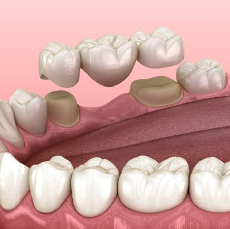 Dental Bridges | Scotia Dental | Halifax Dentist