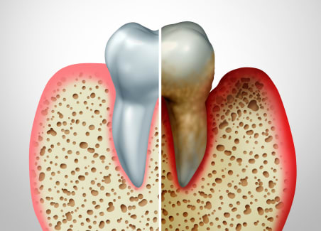 Periodontics & Gum Health, Scotia Dental in Halifax