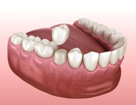 Dental Crowns | Scotia Dental | Halifax Dentist
