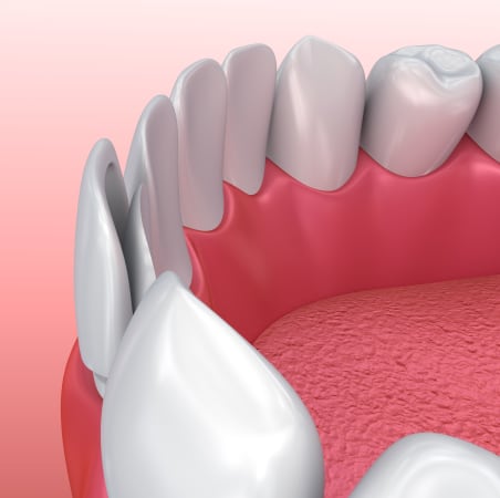 Dental Veneers | Scotia Dental | Halifax Dentist